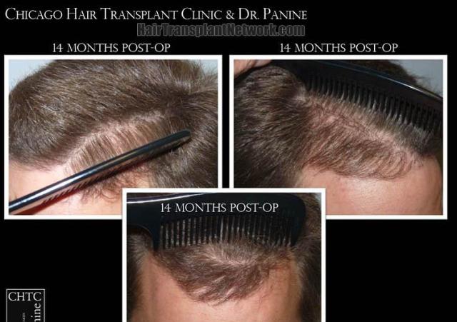 Hair transplantation surgery before and after pictures