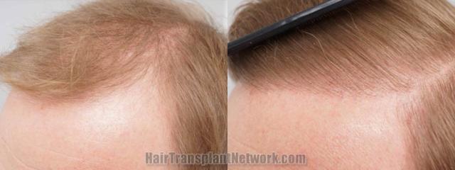 Hair restoration procedure before and after pictures