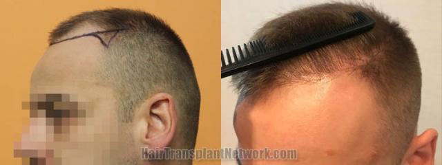 Hair restoration procedure before and after pictures