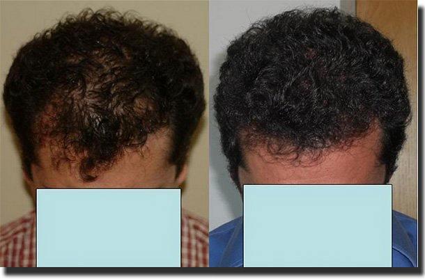 Hair restoration procedure results