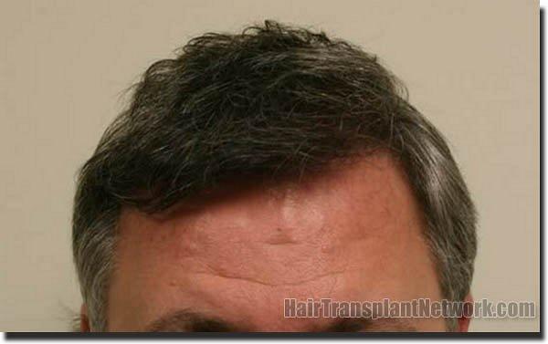 Hair restoration procedure results