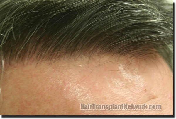 Hair restoration procedure results