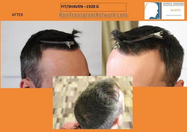 Hair restoration surgery before and after photos