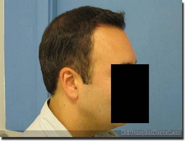 Hair restoration procedure results