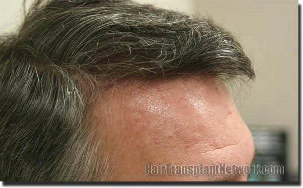 Hair restoration procedure results