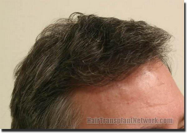 Hair restoration procedure results