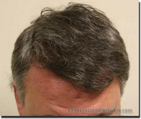 Hair restoration procedure results