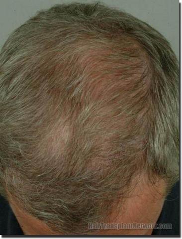 Hair restoration procedure results