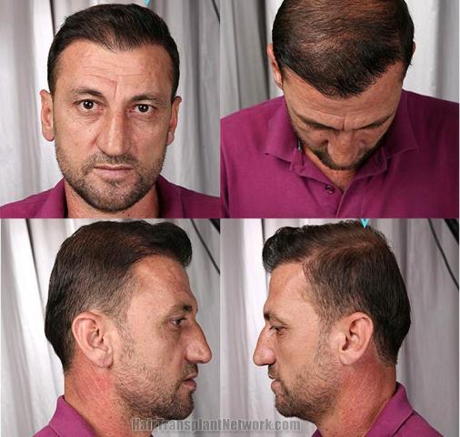 Hair restoration procedure results