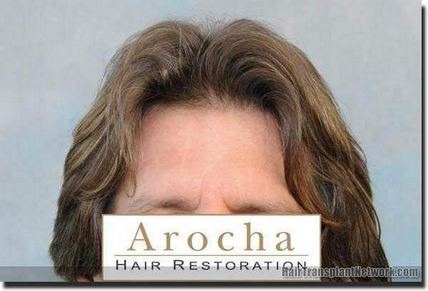 Hair restoration procedure results