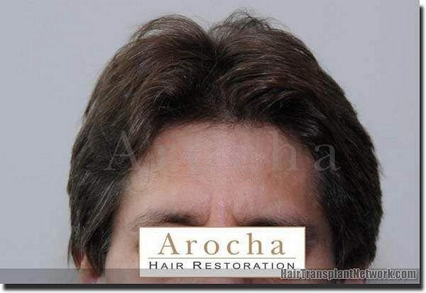 Hair restoration procedure results