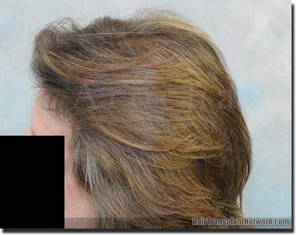 Hair restoration procedure results