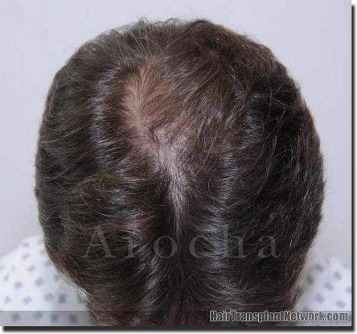 Hair restoration procedure results