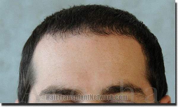 Hair restoration procedure results