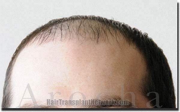 Hair restoration procedure results