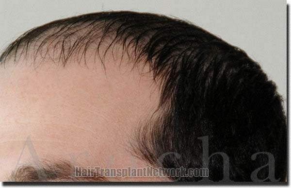 Hair restoration procedure results