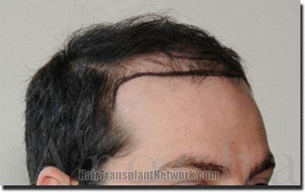 Hair restoration procedure results