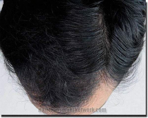 Hair restoration procedure results