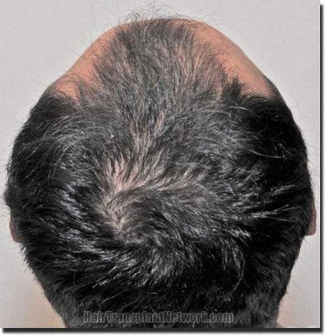 Hair restoration procedure results