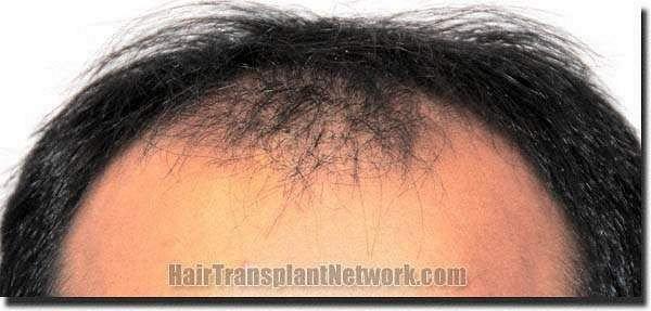 Hair restoration procedure results