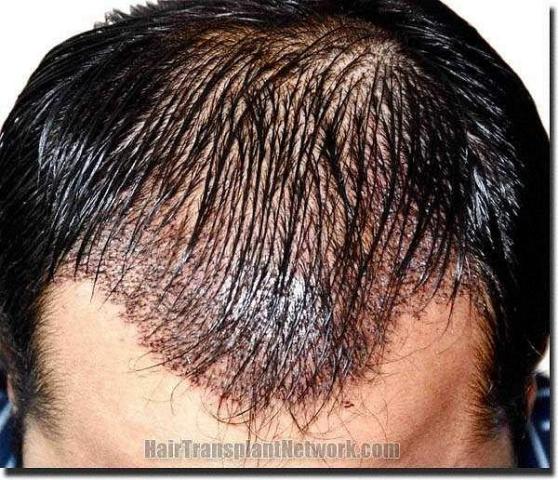 Hair restoration procedure results