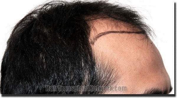 Hair restoration procedure results