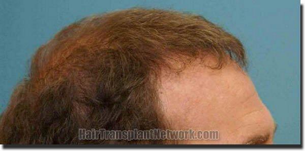 Hair restoration procedure results