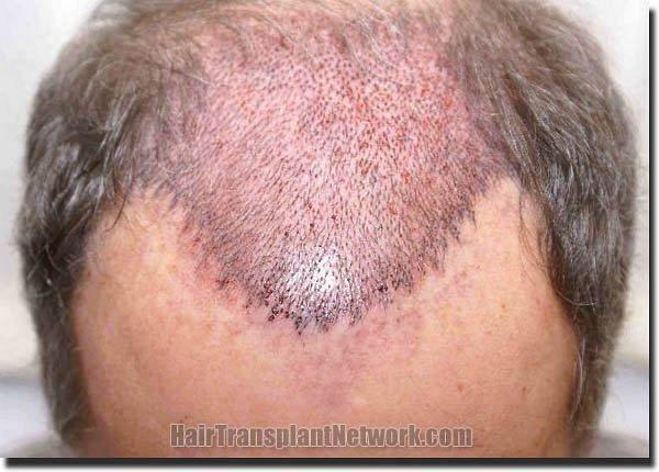 Hair restoration procedure results