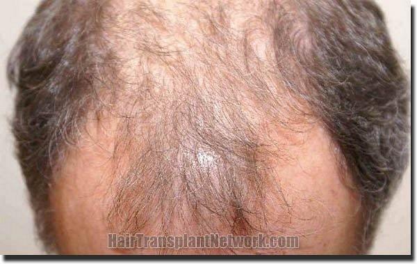 Hair restoration procedure results