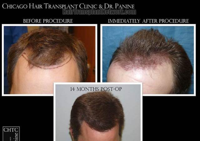 Hair restoration procedure before and after results