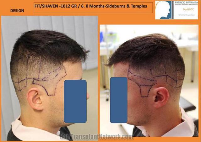 Hair transplantation surgery before photos