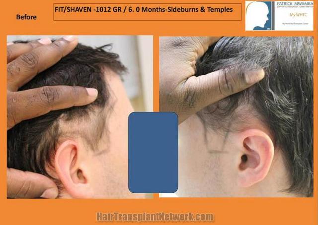 Hair transplantation surgery before images