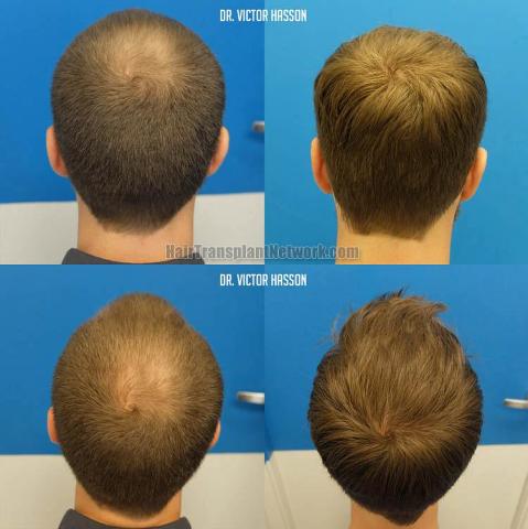 Back view before and after hair transplantation photos