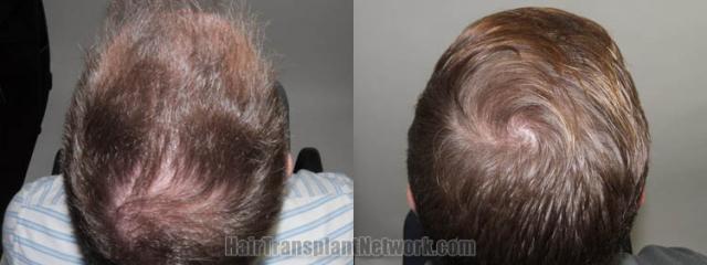 Top view - Before and after surgical hair replacement