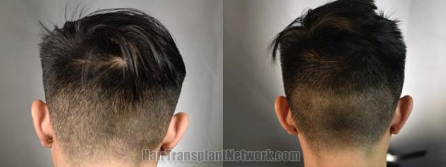 Back view before and after hair transplantation 