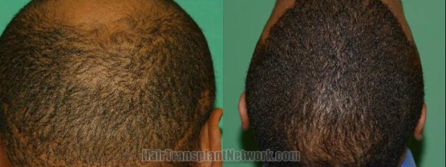 Back view before and after hair transplantation 