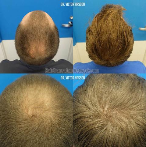 Hair transplant surgery before and after pictures