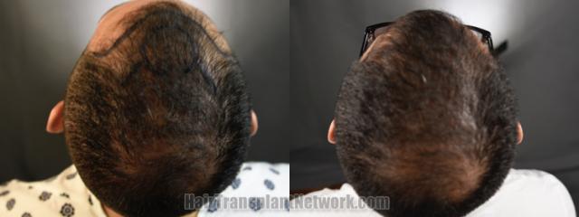 Back view before and after hair transplantation 