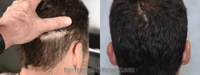 Back view before and after hair transplantation 