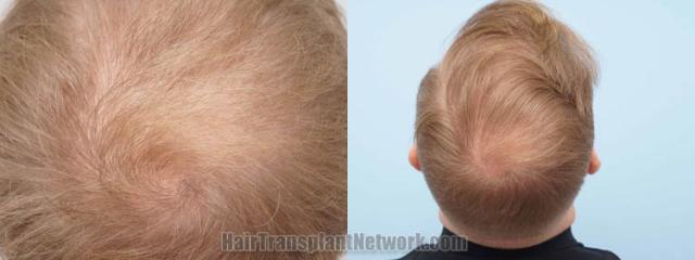 Top view - Before and after surgical hair replacement