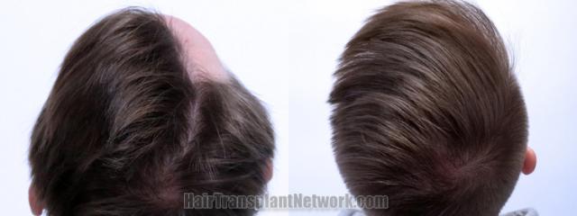 Back view before and after hair transplantation 