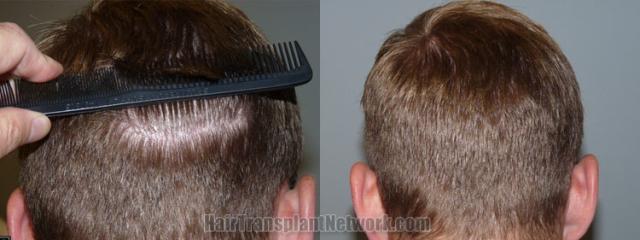 Back view before and after hair transplantation 