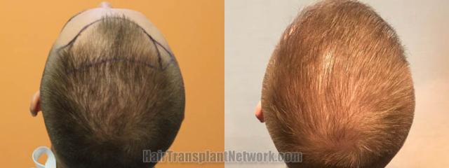 Top view - Before and after surgical hair replacement