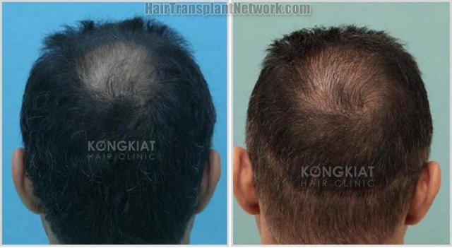 Hair transplantation procedure before and after photographs