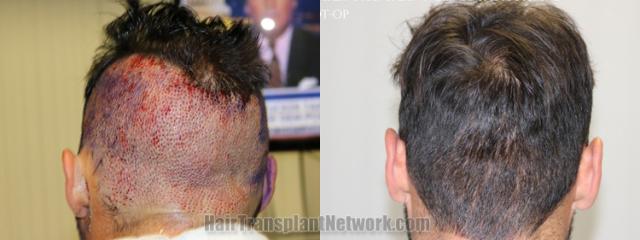 Back view before and after hair transplantation 