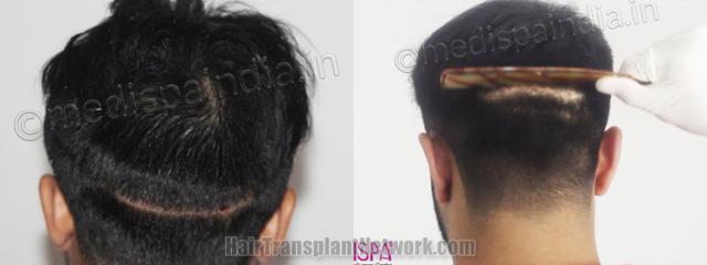 Back view before and after hair transplantation 