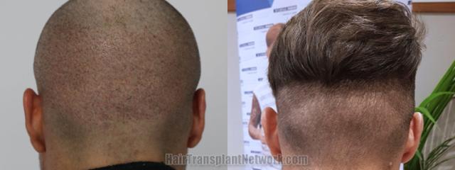 Back view before and after hair transplantation 