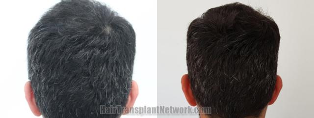 Back view before and after hair transplantation 