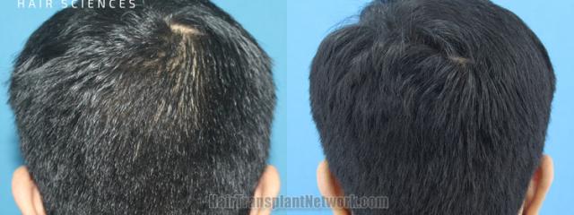 Back view before and after hair transplantation 