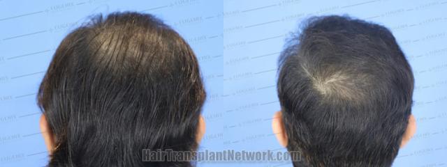 Back view before and after hair transplantation 